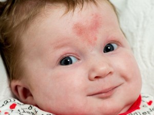 ทารก ปานแดงรูปหัวใจ วาเลนไทน์