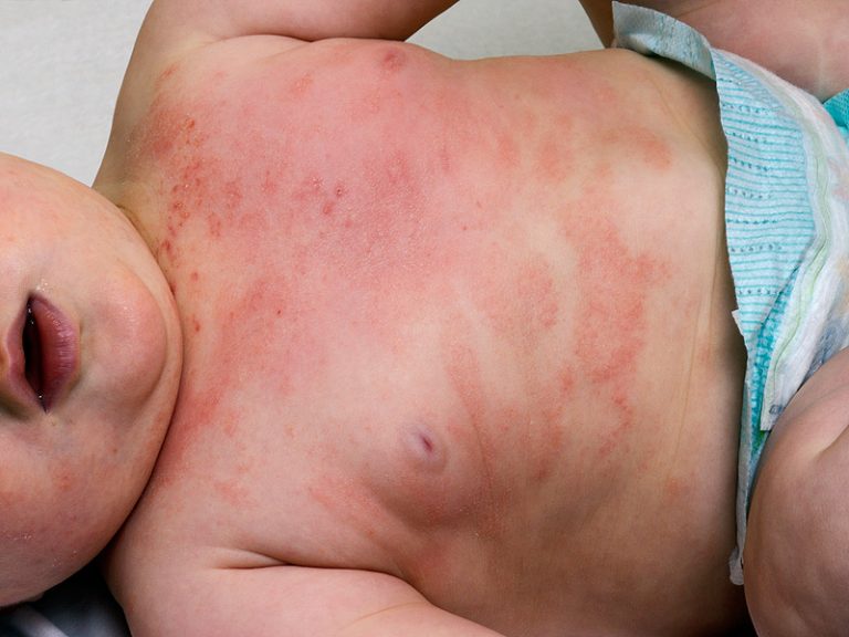 โรคผิวหนังอักเสบภูมิแพ้ atopic dermatitis
