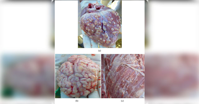 ซีสต์ตืดหมู