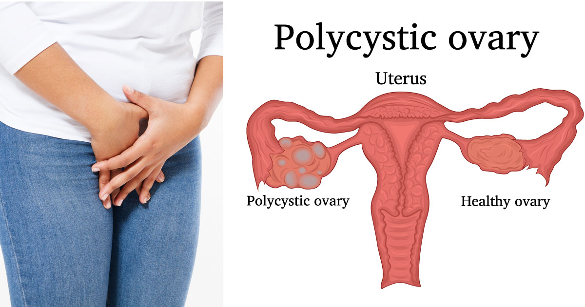 โรค PCOS