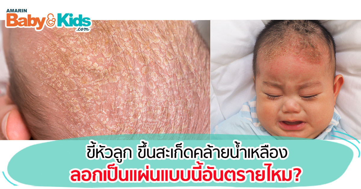 ไขบนศีรษะลูก เกิดจากอะไร ไขบนหัวทารก ดูแลอย่างไร - Amarin Baby & Kids ไขบนศีรษะลูก เกิดจากอะไร ไขบนหัวทารก ดูแลอย่างไร - Amarin Baby & Kids