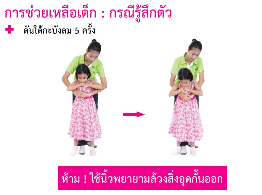 การช่วยเหลือ เด็ก สำลัก