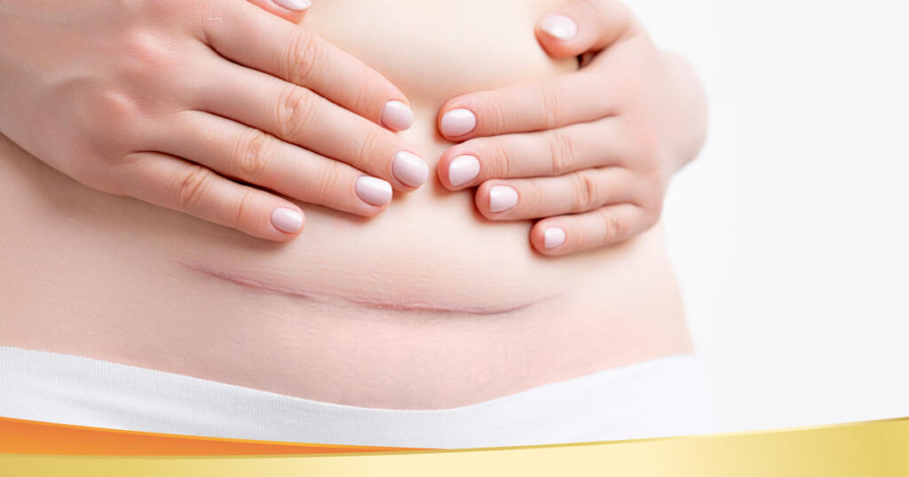 เด็กผ่าคลอดเจนใหม่, นมแม่, สมองไว, ภูมิคุ้มกัน, แอลฟาแล็ค สฟิงโกไมอีลิน, บี แล็กทิส, B. lactis,